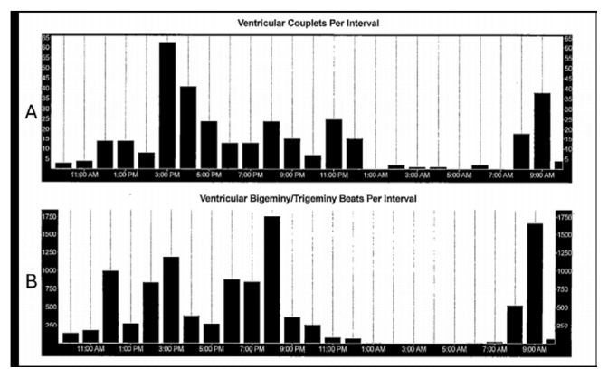 Premature Ventricular Contractions as an Underrecognized Cause of Chronic Cough: A Case of Misdiagnosis in a Patient with Bronchiectasis.