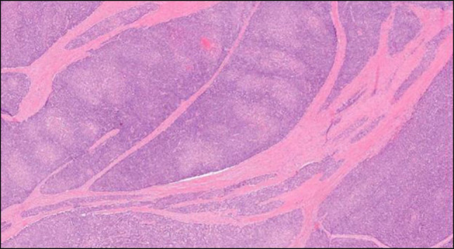 Adult-Onset Pancreatoblastoma.