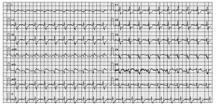 Computed tomography angiography diagnosis of Marfan syndrome complicated with fulminant myocarditis under extracorporeal membrane oxygenation support: a case report.