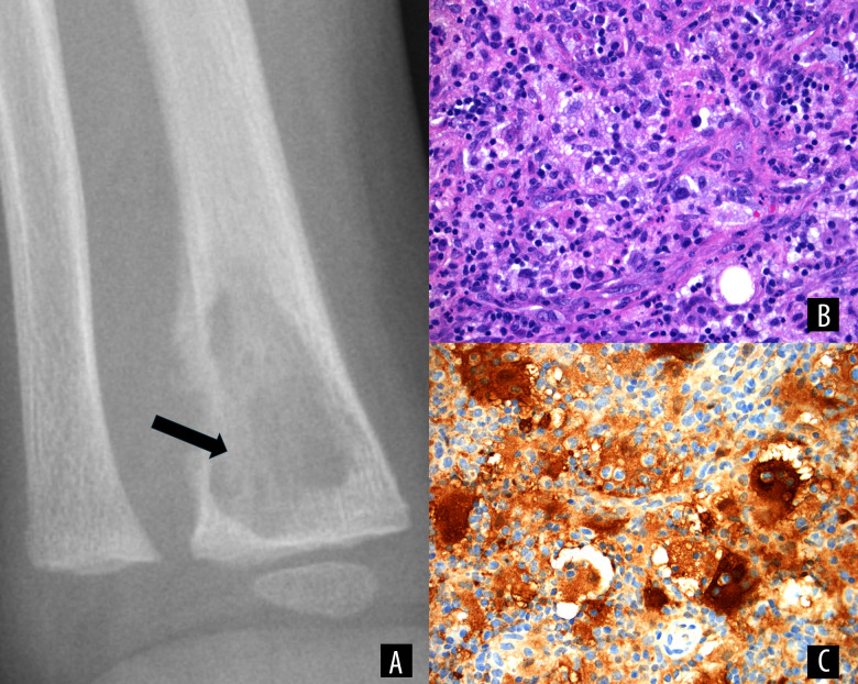 Extranodal Rosai-Dorfman Disease in a Pediatric Patient: A Case Report.