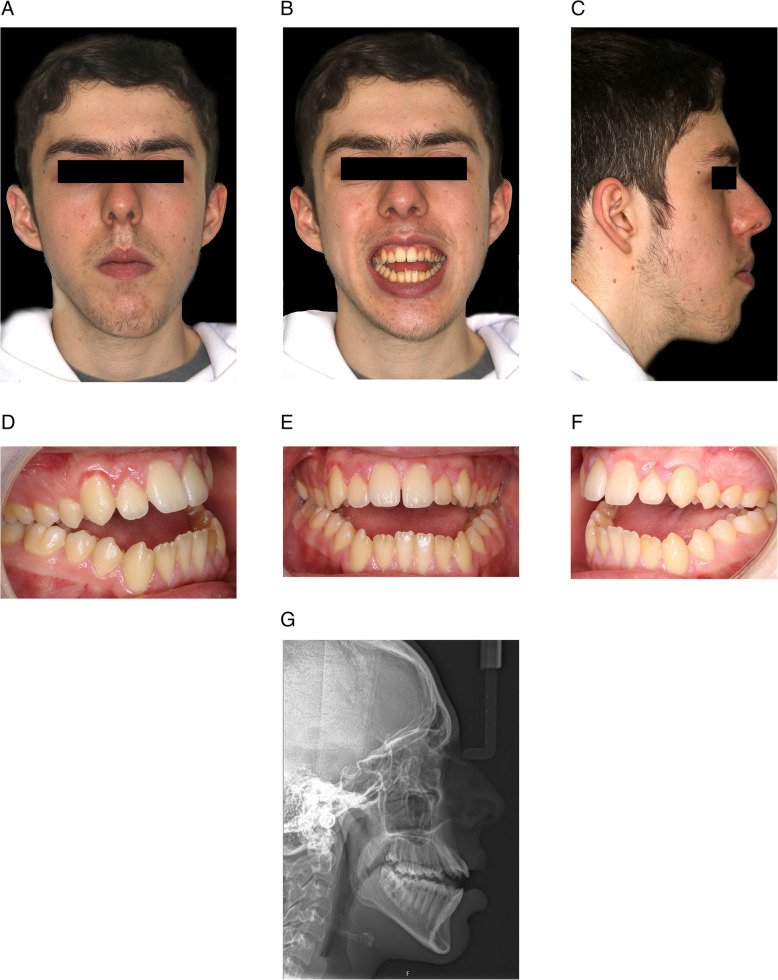 A novel technique to improve postoperative stability of orthognathic surgical anterior open bite correction using temporary anchorage devices: a case report.