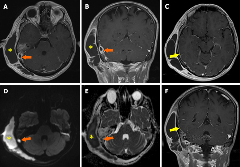 Role of imaging in chronic otitis media and its complications.