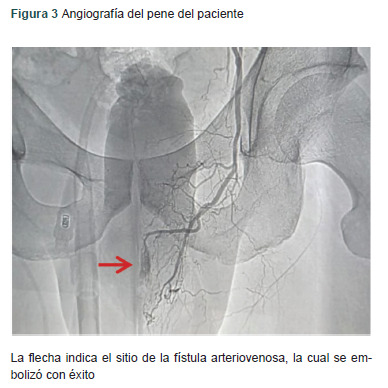 [High-flow priapism without a history of trauma: A case report].