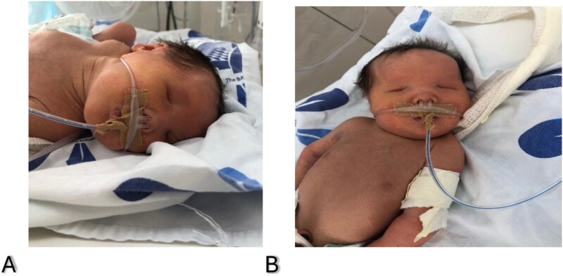 Bilateral anophthalmia in a neonate: a syndromic presentation with multisystem anomalies and diagnostic challenges.