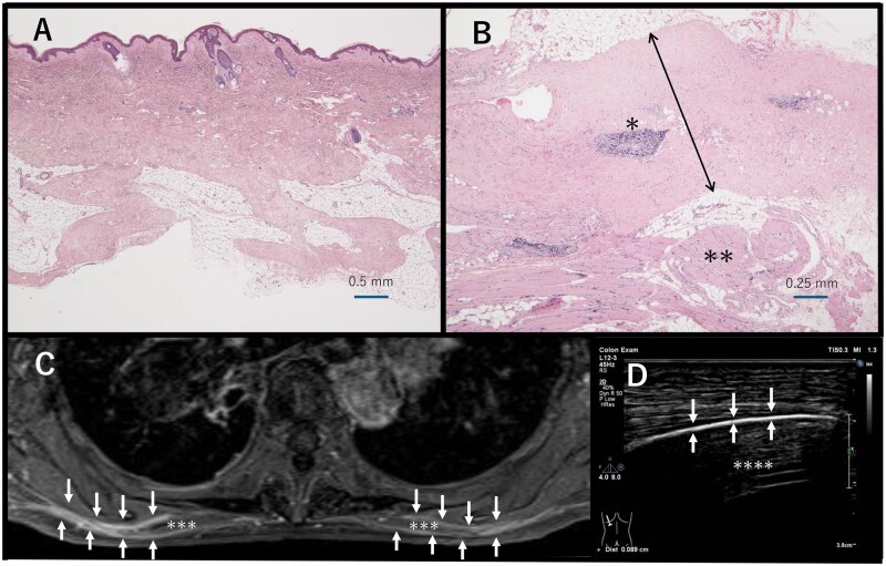 Diffuse fasciitis with restrictive ventilatory impairment and type 2 respiratory failure: a rare case report.