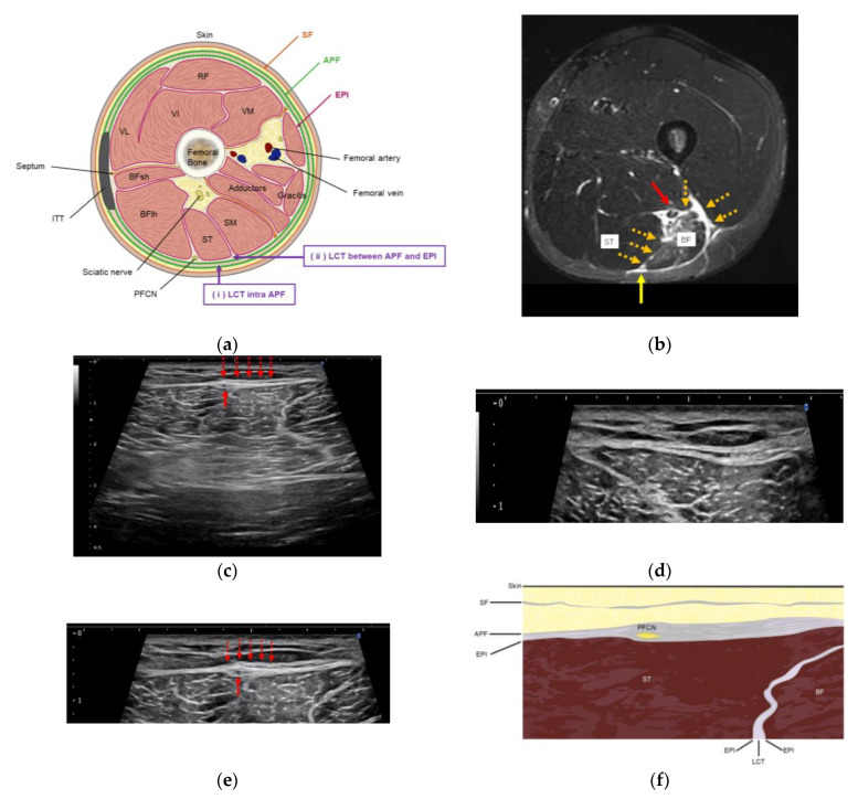 Ultrasound-Guided Fascial Hydrorelease for Persistent Pain After Hamstring Injury.