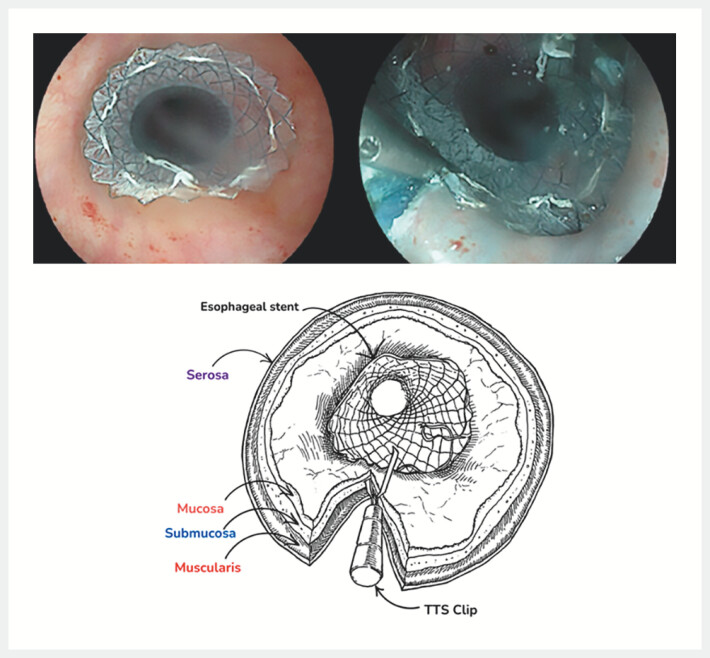 Evaluation of the clip anchorage technique using mucosal elevation and incision in prevention of esophageal stent migration.