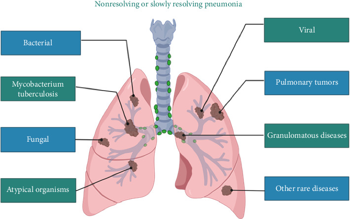 Improved Etiological Diagnosis of Nonresolving or Slowly Resolving Pneumonia Through Combined Endobronchial Ultrasound-Guided Biopsy and Metagenomic Sequencing.