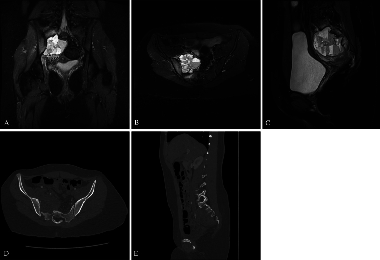 S3 sacral-alar iliac screws application in partial sacral resection for an aneurysmal bone cyst: illustrative case.