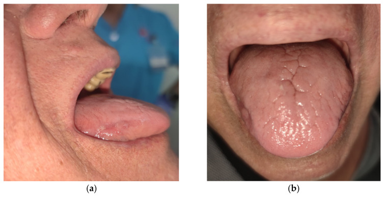 Chronic Hyperplastic Candidiasis-An Adverse Event of Secukinumab in the Oral Cavity: A Case Report and Literature Review.