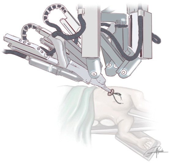 Complex uniportal robotic-assisted sleeve resections under spontaneous ventilation and with double lumen intubation: a case series and a narrative review of the literature.