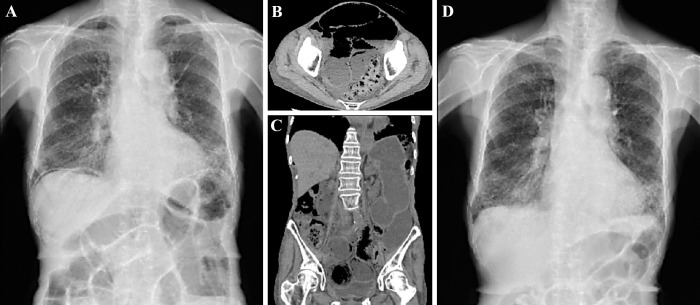 Pneumatosis Intestinalis Induced by Nintedanib.