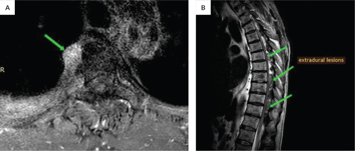 Spinal Extramedullary Hematopoiesis Causing Spinal Cord Compression in Radiation-induced Bone Marrow Aplasia: A Case Report.
