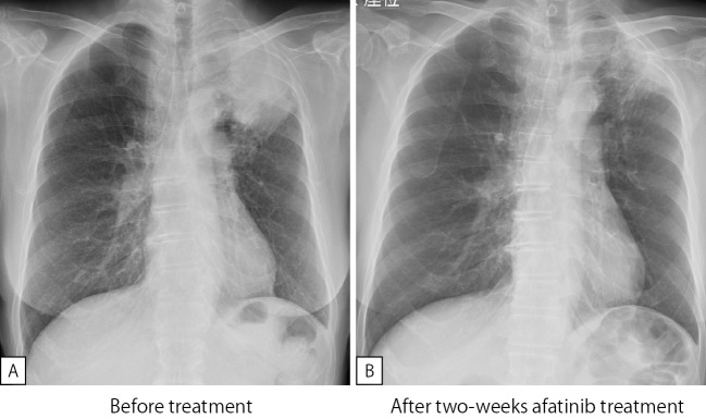 The Afatinib Response to EGFR E709G-mutated Lung Cancer.