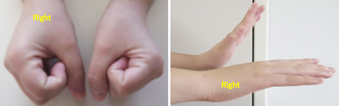 Restricted Movement Associated with Unilateral Diffuse Fasciitis.