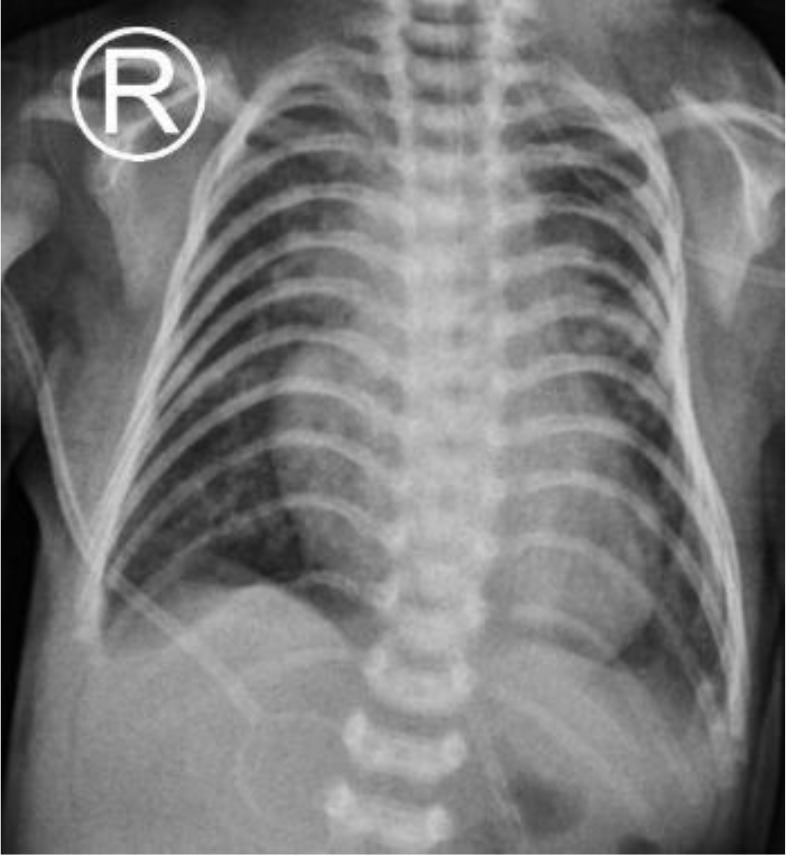 Customized feeding plate for nutritional and respiratory support in an infant with Pierre Robin sequence and cleft palate complicated by severe respiratory infections: A case report.