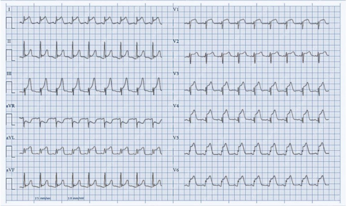 Tackling the ST elevation in leptospirosis: A double-edged sword between bleeding and thrombosis - A case report.