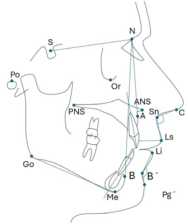 Cephalometric features associated with the mentolabial angle and lower lip eversion in young adults: A cross-sectional study.