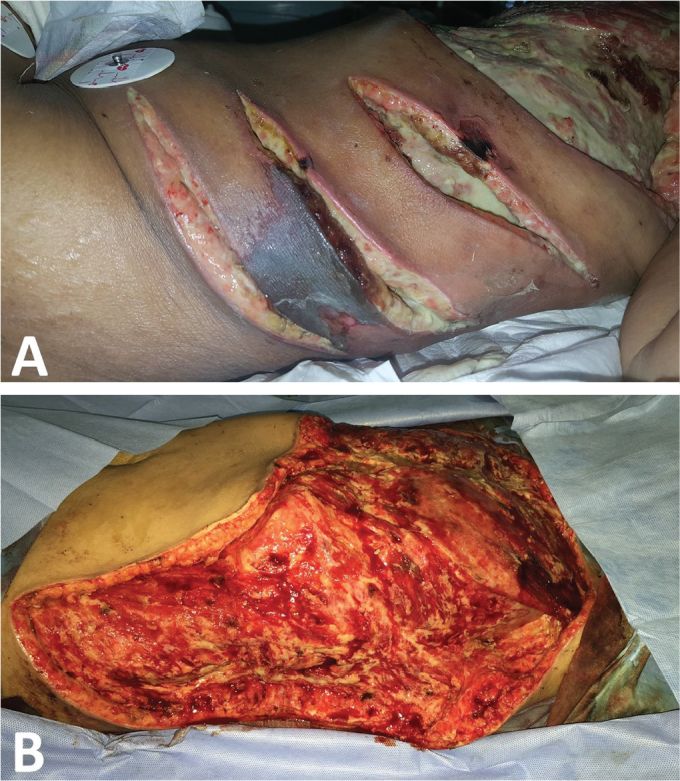 Necrotizing Fasciitis of Bilateral Breasts following Unilateral Modified Radical Mastectomy for Invasive Ductal Carcinoma: A Case Report and Review of Literature.