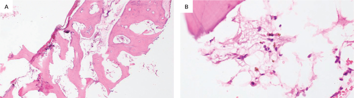 Spinal Extramedullary Hematopoiesis Causing Spinal Cord Compression in Radiation-induced Bone Marrow Aplasia: A Case Report.