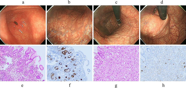 Rapid Development of a Hemorrhagic Hyperplastic Polyp in a Patient with Evolving Autoimmune Gastritis after Helicobacter pylori Eradication.
