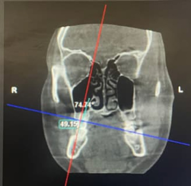 Evaluation of the association between tongue posture and the transverse dental compensation in Class III skeletal patients - a retrospective, record-based study.