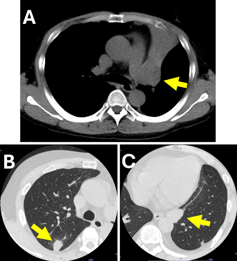 Post-Transplant Lymphoproliferative Disorder Which Developed 45 Years After Kidney Transplantation.