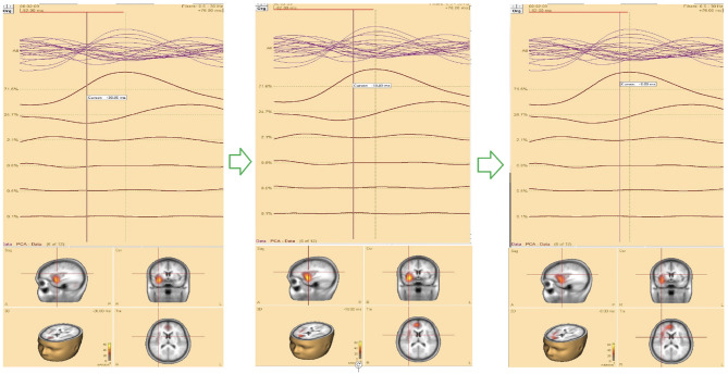 Epileptic brain imaging by source localization CLARA supported by ictal-based semiology and VEEG in resource-limited settings.