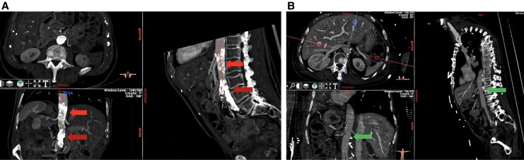 Aorta unveiled: the crucial role of imaging in diagnosing and managing aortic disease-a review.