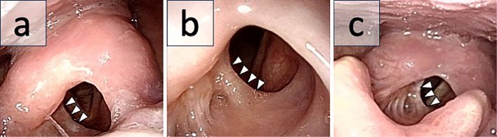 Laryngeal Web Caused by Mucous Membrane Pemphigoid.