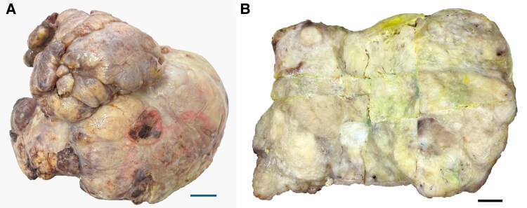 Intrapericardial localization of solitary fibrous tumour: a case report.