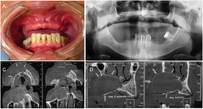 Maxillary Glandular Odontogenic Cyst - report of 3 cases and literature review.