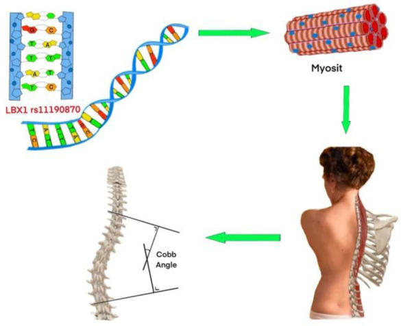 Role of <i>LBX1</i> rs11190870 polymorphism in adolescent idiopathic scoliosis in the Acehnese population: A preliminary study.