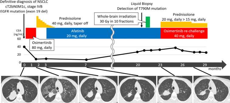 Successful Switch to Afatinib and Osimertinib Rechallenge with Corticosteroids after Osimertinib-induced Interstitial Lung Disease: A Case Report and Literature Review.