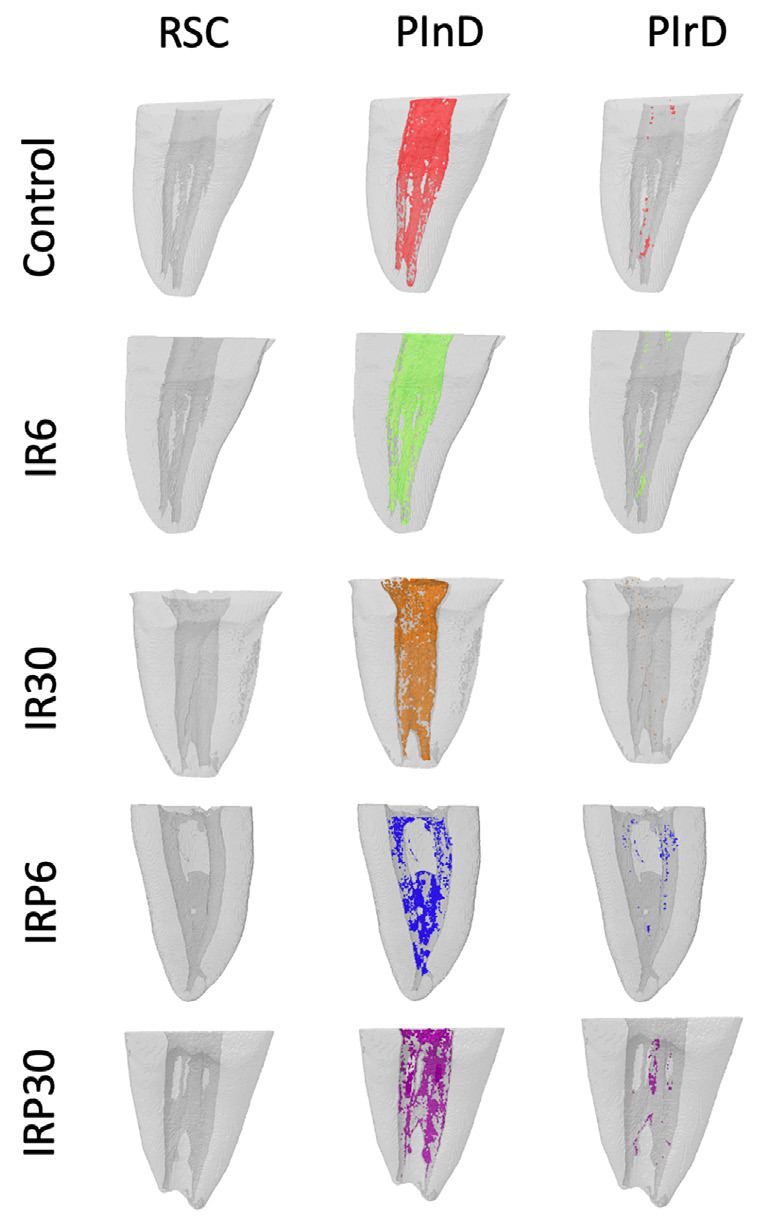 Debris Removal from Mandibular Molars Using Different Irrigation Volumes and Ultrasonic Tips: Micro-CT Study.