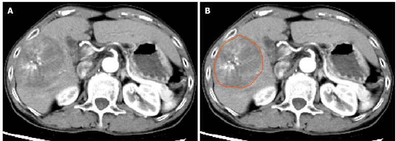 Computed tomography-based deep learning and multi-instance learning for predicting microvascular invasion and prognosis in hepatocellular carcinoma.