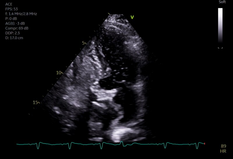 Platypnoea-orthodeoxia syndrome following transcatheter aortic valve implantation complicated by aortic annular rupture: a case report.
