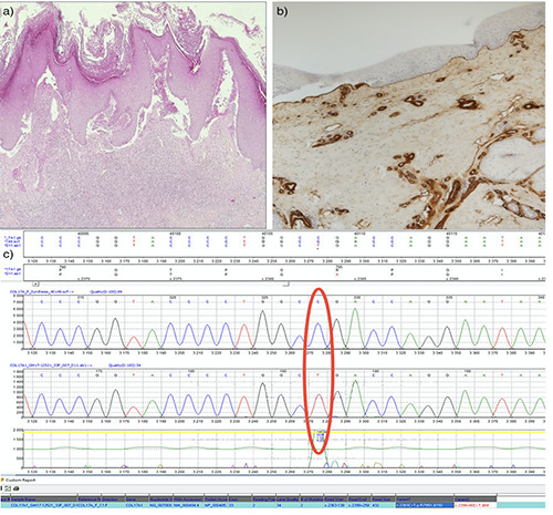 Localized variant of junctional epidermolysis bullosa with R795X mutation.