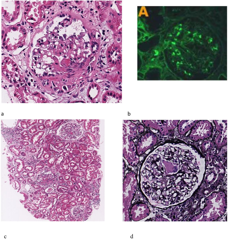 IgA nephropathy with crescent cell lesions in a human brucellosis patient: a case report.