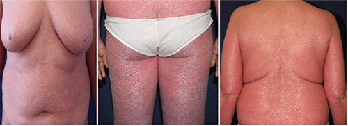 Refractory pityriasis rubra pilaris treated with abrocitinib.