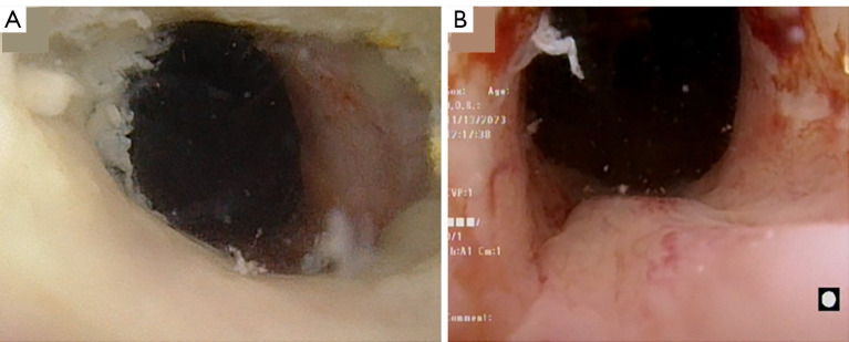Endoscopic buccal urethroplasty for membranous stricture disease.