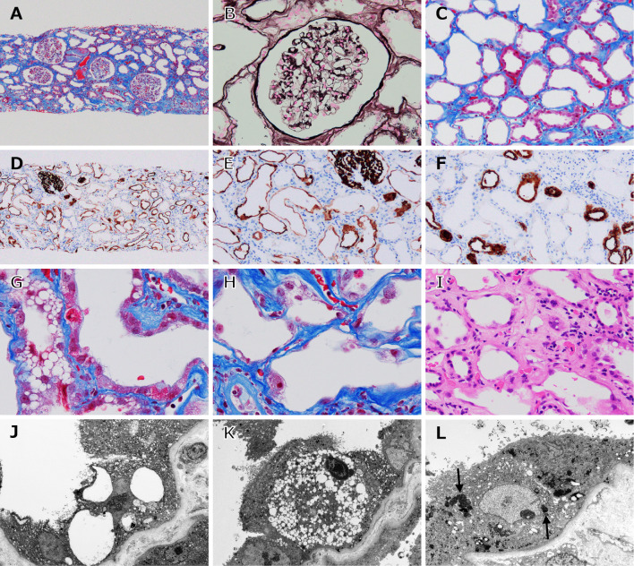 Acute Kidney Injury and Fanconi Syndrome Caused by a Red Yeast Rice Supplement.