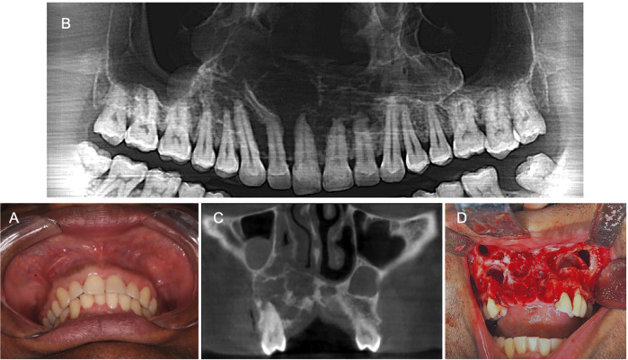 Maxillary Glandular Odontogenic Cyst - report of 3 cases and literature review.