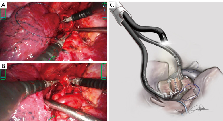 Complex uniportal robotic-assisted sleeve resections under spontaneous ventilation and with double lumen intubation: a case series and a narrative review of the literature.