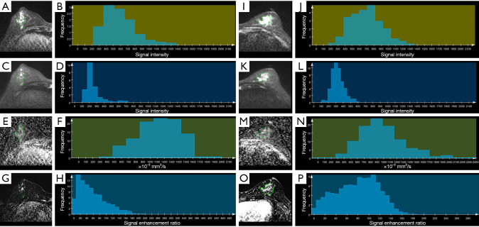 Improved diagnostic value of whole-lesion histogram and texture analyses on multiparametric breast MRI for papillary neoplasms with non-mass enhancement.