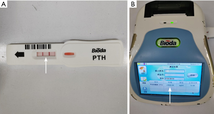 Evaluation of the effectiveness of near-infrared autofluorescence (NIRAF) imaging combined with immunocolloidal gold technique (ICGT) in identifying and protecting parathyroid glands during thyroid cancer surgery.
