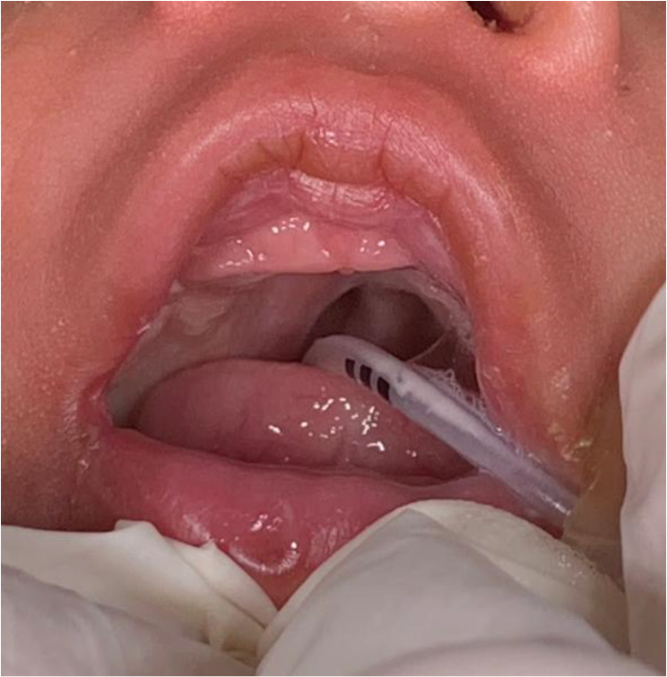 Customized feeding plate for nutritional and respiratory support in an infant with Pierre Robin sequence and cleft palate complicated by severe respiratory infections: A case report.