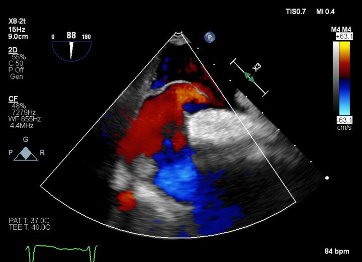 Platypnoea-orthodeoxia syndrome following transcatheter aortic valve implantation complicated by aortic annular rupture: a case report.