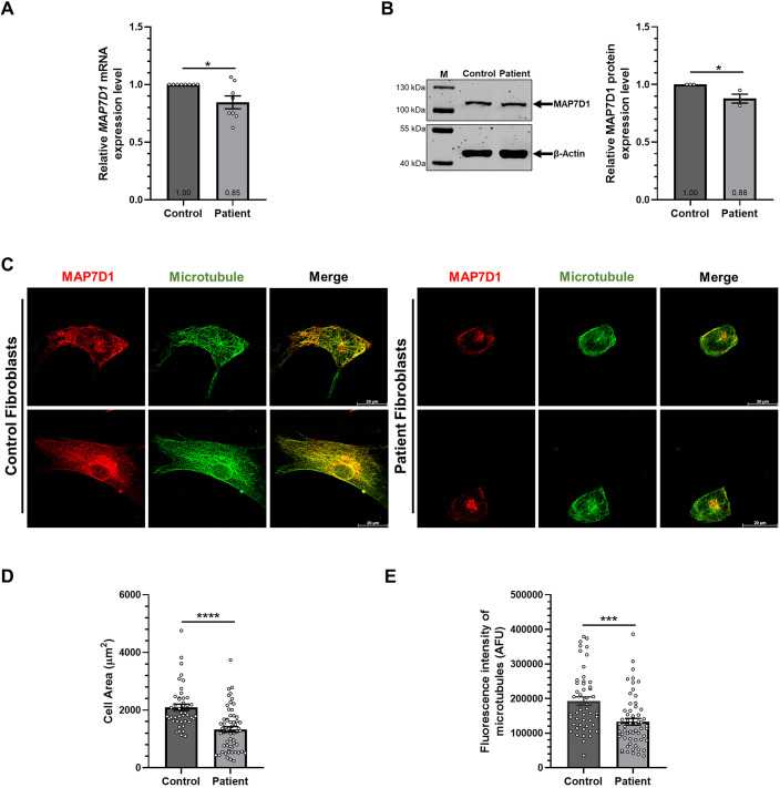 A novel MAP7D1 mutation causes mitotic defects and RPS14 accumulation in Shwachman-Diamond syndrome patient cells.