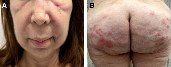 Severe Complications Due to Biopolymers in a Patient With Autoimmune Disease: A Case Report and Review of the Literature.